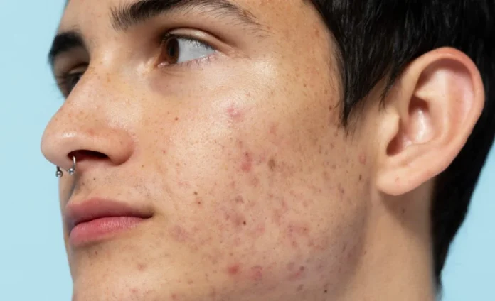 Acne-1140x694